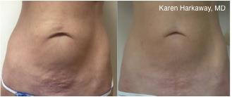 11 abdomen Harkaway.jpg