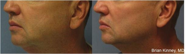 8 male neck kinney.jpg