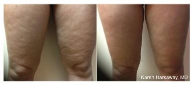 10 cellulite.jpg