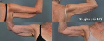 Non-Surgical Skin Tightening of Arms, Neck, Tummy, and Knees with  ThermiTight - Peña Plastic Surgery