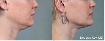 5 Neck 2 mos.jpg